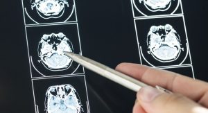 Read more about the article Cientistas criam exame inédito que identifica com alta precisão Alzheimer em estágio inicial