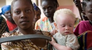 Read more about the article Pai é preso em Moçambique por tentar vender os três filhos albinos