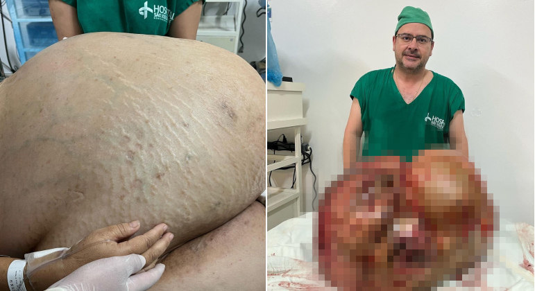 You are currently viewing Mulher pensou que estava engordando, mas tinha um tumor de 46 kg; entenda o caso