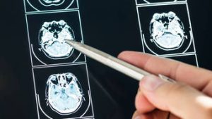 Read more about the article Novo remédio pode mudar o destino de pacientes com Alzheimer em estágio inicial